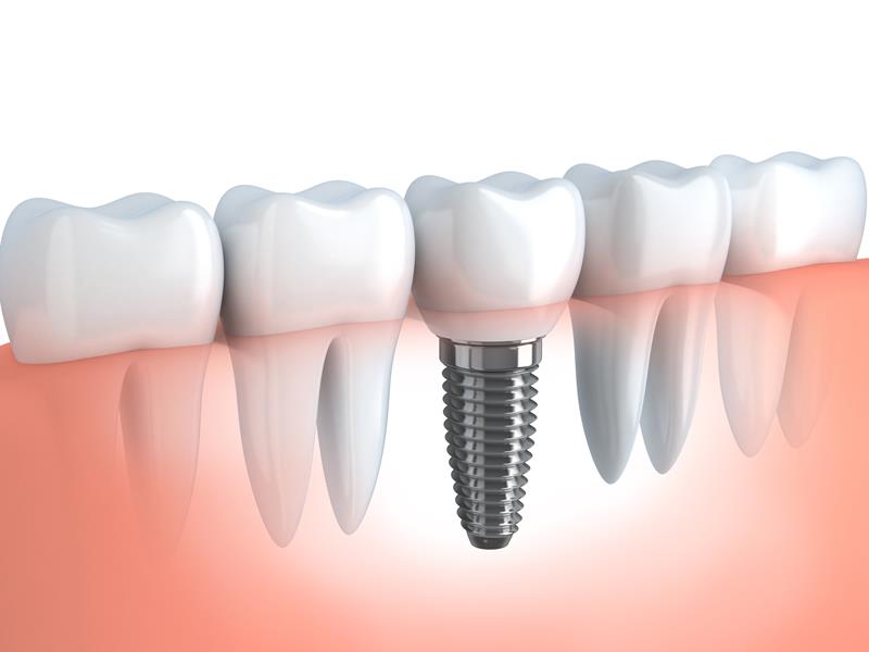 Dental Implants  Miami, FL 